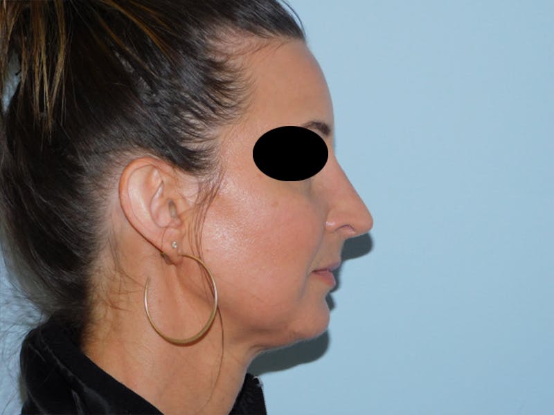 Rhinoplasty Before & After Gallery - Patient 133066496 - Image 4