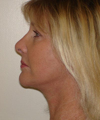 Facelift Before & After Gallery - Patient 133066474 - Image 2