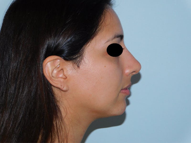 Non-Surgical Rhinoplasty and Injectable Fillers Before & After Gallery - Patient 133066471 - Image 2