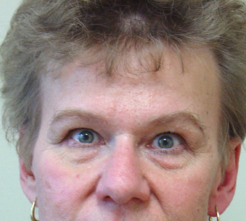 Blepharoplasty (Eyelid Lift) Before & After Gallery - Patient 133066475 - Image 1
