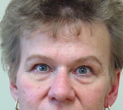 Blepharoplasty (Eyelid Lift) Before & After Gallery - Patient 133066475 - Image 1