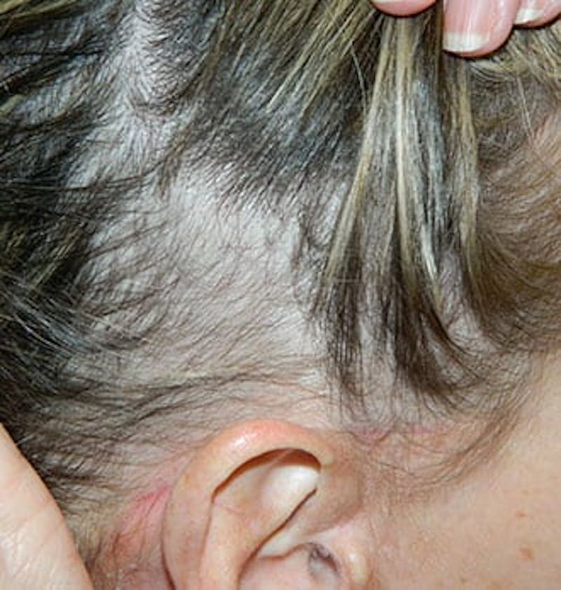 PRP Injections for Hair Loss Before & After Gallery - Patient 133066472 - Image 1