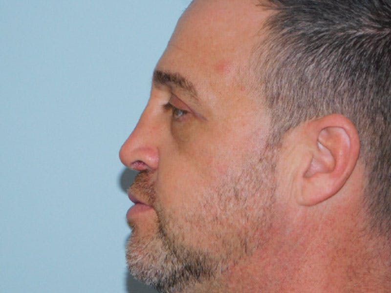 Revision Rhinoplasty Before & After Gallery - Patient 133066477 - Image 4