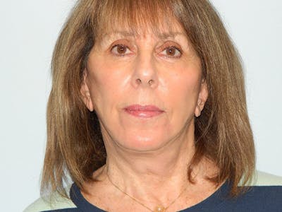 Mini-Facelift Before & After Gallery - Patient 133066476 - Image 2