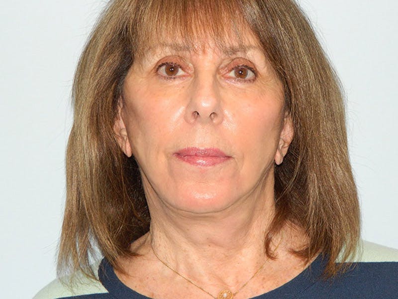 Mini-Facelift Before & After Gallery - Patient 133066476 - Image 2