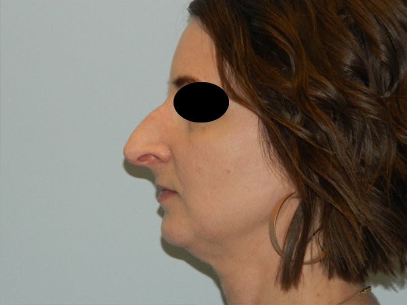 Rhinoplasty Before & After Gallery - Patient 133066496 - Image 5