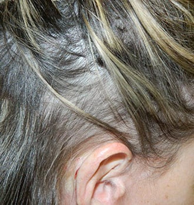 PRP Injections for Hair Loss Before & After Gallery - Patient 133066472 - Image 2