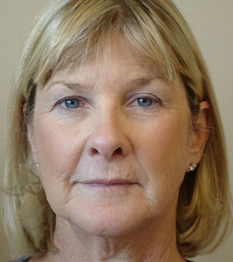 Facelift Before & After Gallery - Patient 133066474 - Image 3