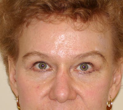 Blepharoplasty (Eyelid Lift) Before & After Gallery - Patient 133066475 - Image 2