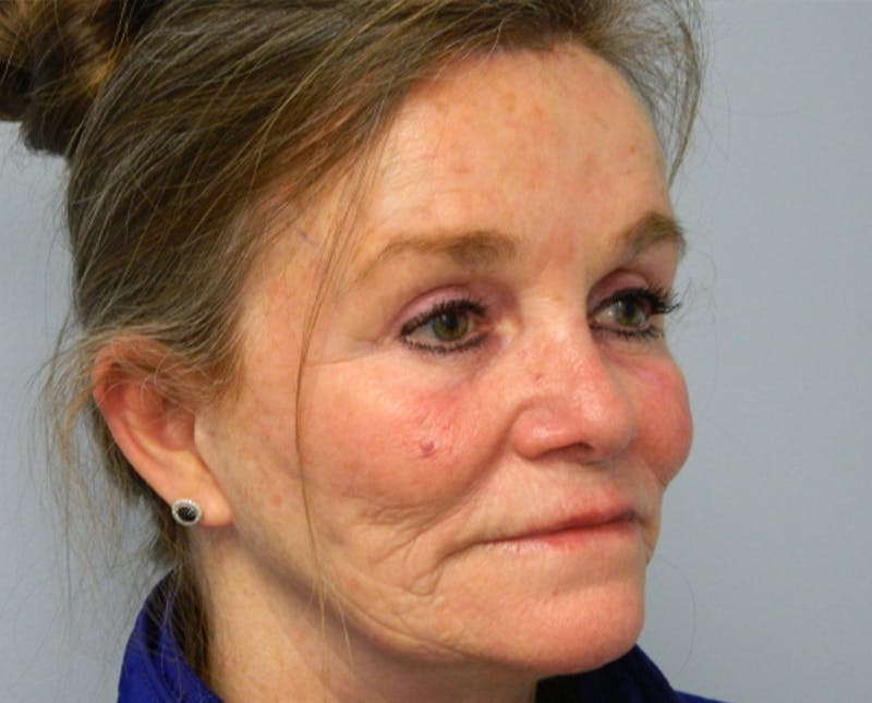 Fraxel Laser Resurfacing Before & After Gallery - Patient 133066482 - Image 1
