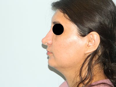 Non-Surgical Rhinoplasty and Injectable Fillers Before & After Gallery - Patient 133066481 - Image 1