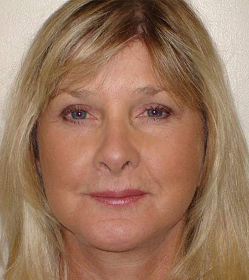 Facelift Before & After Gallery - Patient 133066474 - Image 4