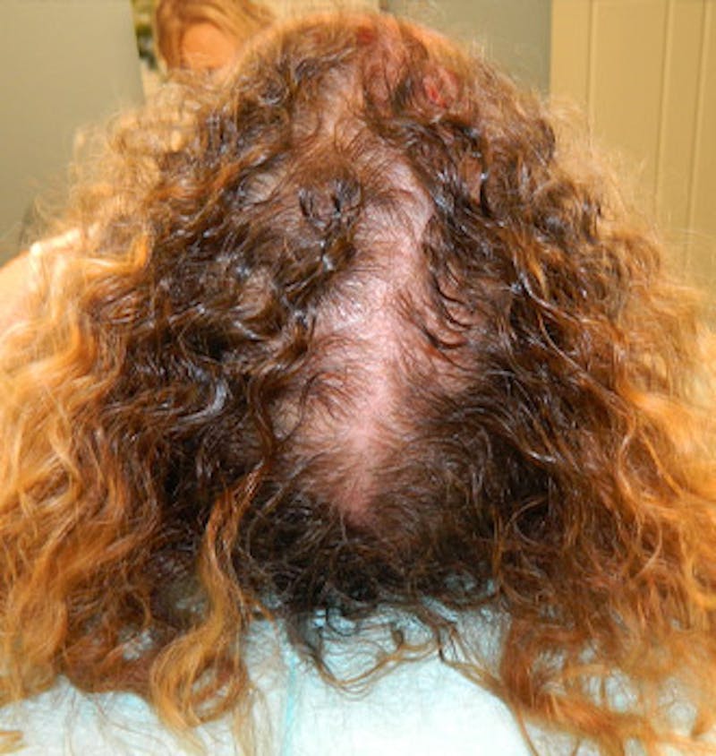 PRP Injections for Hair Loss Before & After Gallery - Patient 133066478 - Image 1