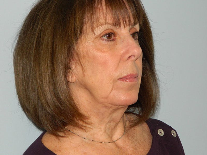 Mini-Facelift Before & After Gallery - Patient 133066476 - Image 3