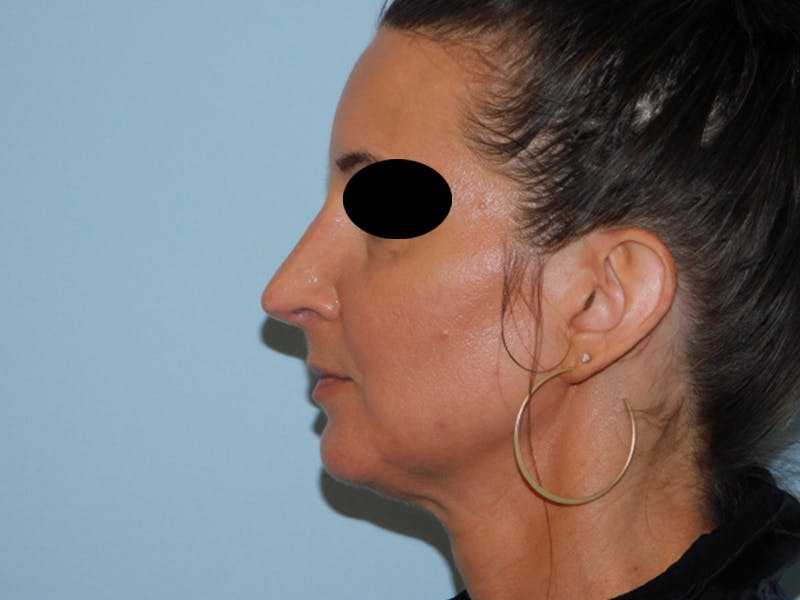 Rhinoplasty Before & After Gallery - Patient 133066496 - Image 6