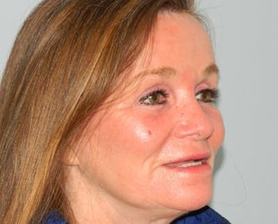 Fraxel Laser Resurfacing Before & After Gallery - Patient 133066482 - Image 2