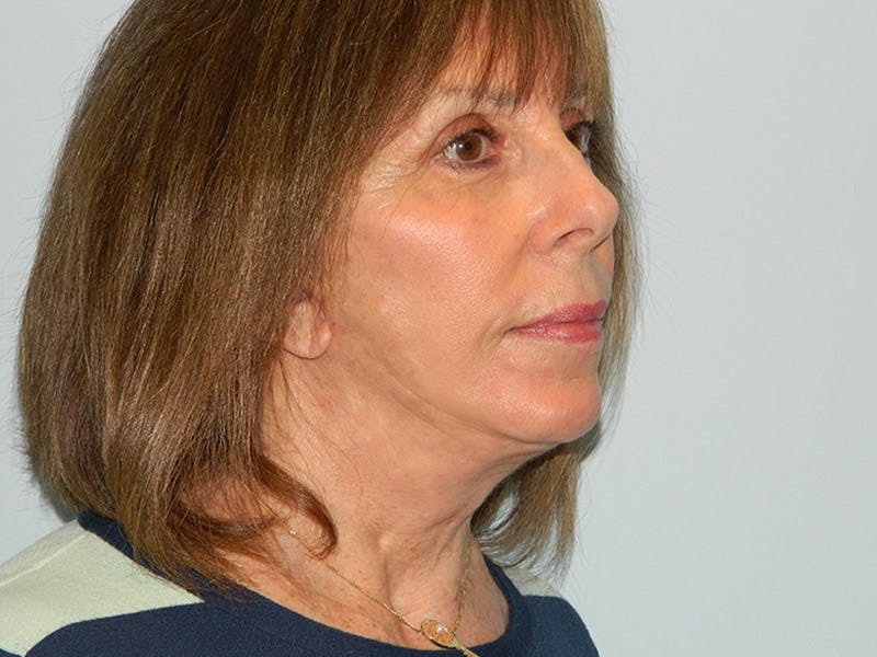 Mini-Facelift Before & After Gallery - Patient 133066476 - Image 4