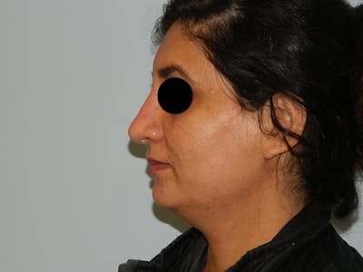 Non-Surgical Rhinoplasty and Injectable Fillers Before & After Gallery - Patient 133066481 - Image 2