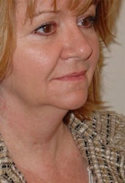 Facelift Before & After Gallery - Patient 133066479 - Image 1