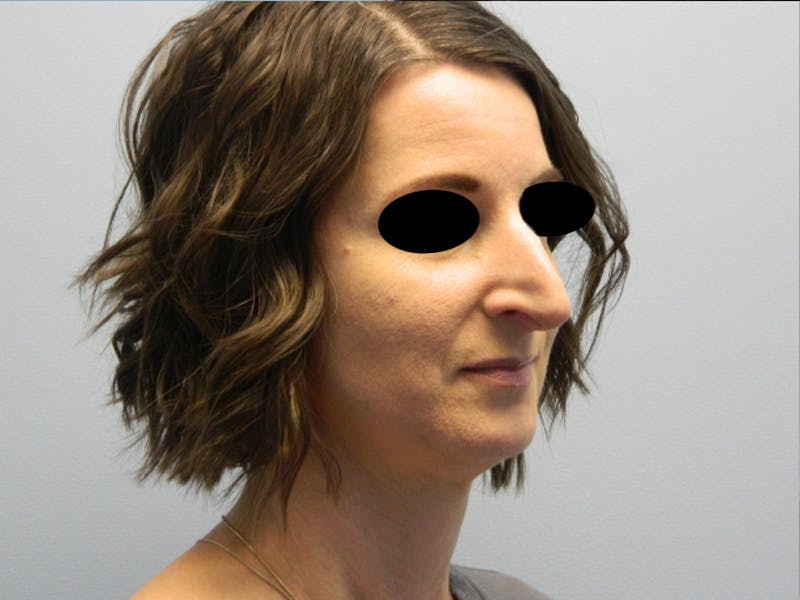 Rhinoplasty Before & After Gallery - Patient 133066496 - Image 7