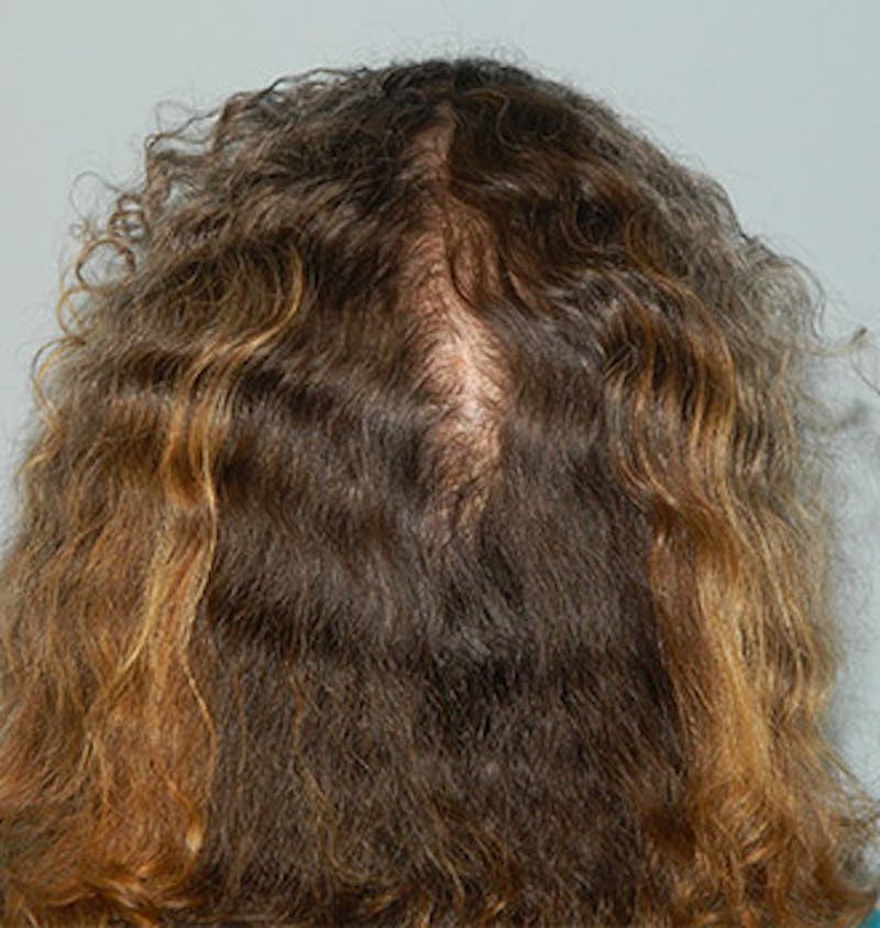 PRP Injections for Hair Loss Before & After Gallery - Patient 133066478 - Image 2
