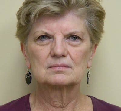 Blepharoplasty (Eyelid Lift) Before & After Gallery - Patient 133066487 - Image 1