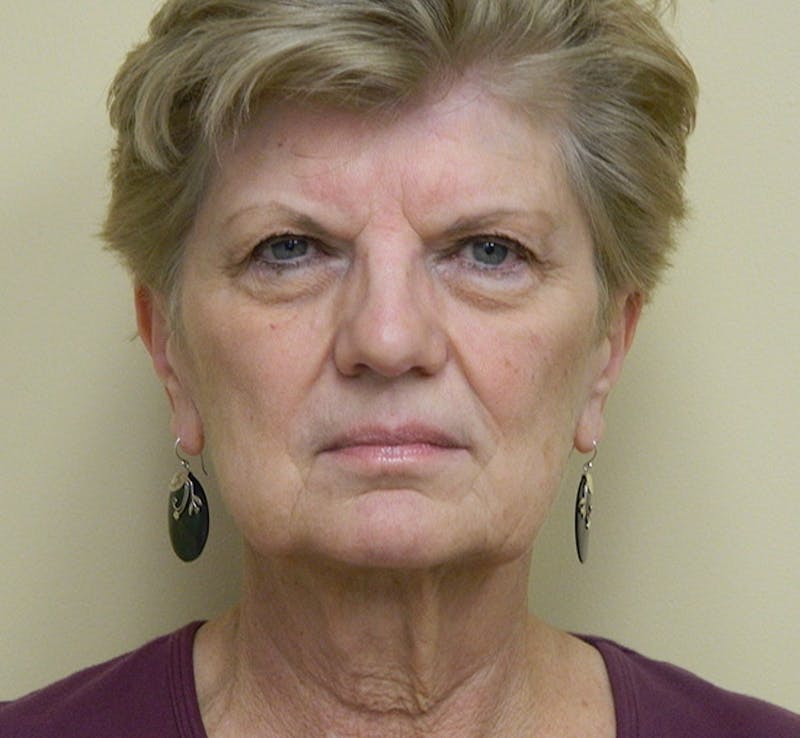 Blepharoplasty (Eyelid Lift) Before & After Gallery - Patient 133066487 - Image 1