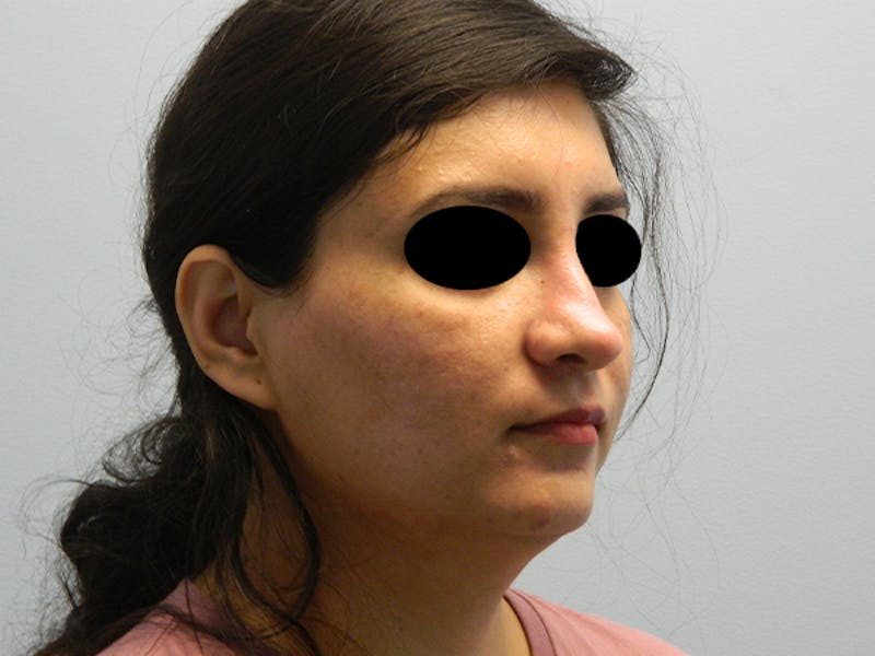 Non-Surgical Rhinoplasty and Injectable Fillers Before & After Gallery - Patient 133066481 - Image 3