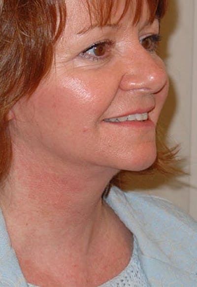Facelift Before & After Gallery - Patient 133066479 - Image 2