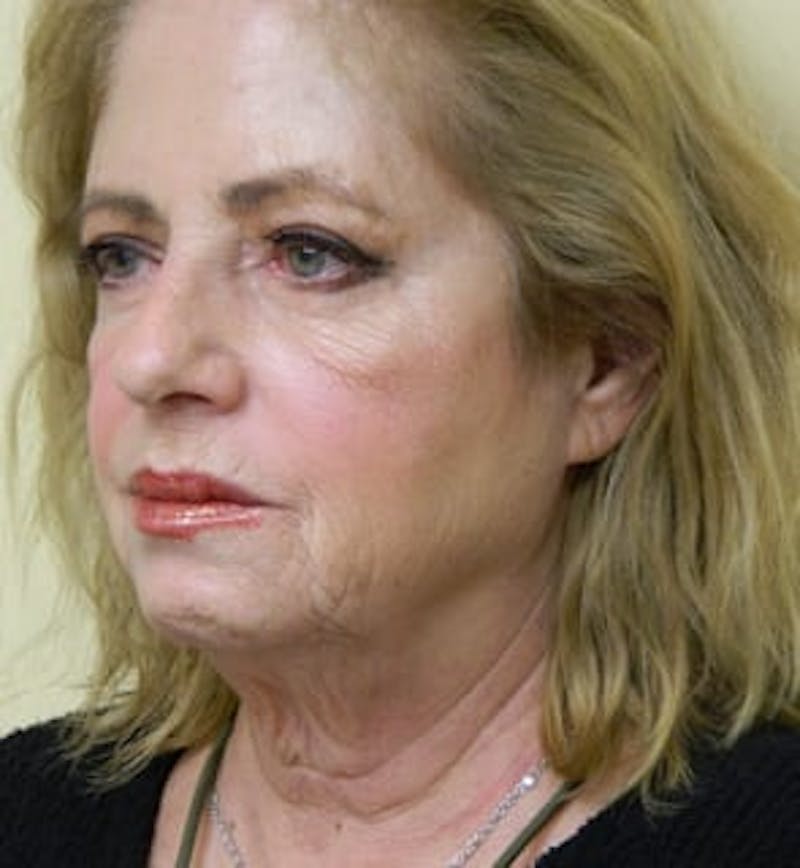 Mini-Facelift Before & After Gallery - Patient 133066480 - Image 1