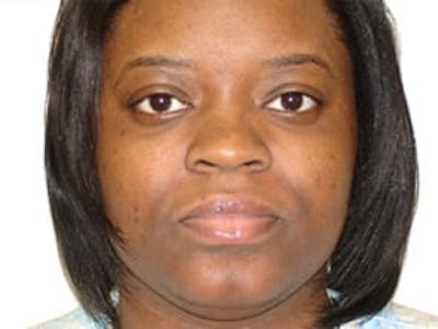 Ultherapy Before & After Gallery - Patient 133066483 - Image 1