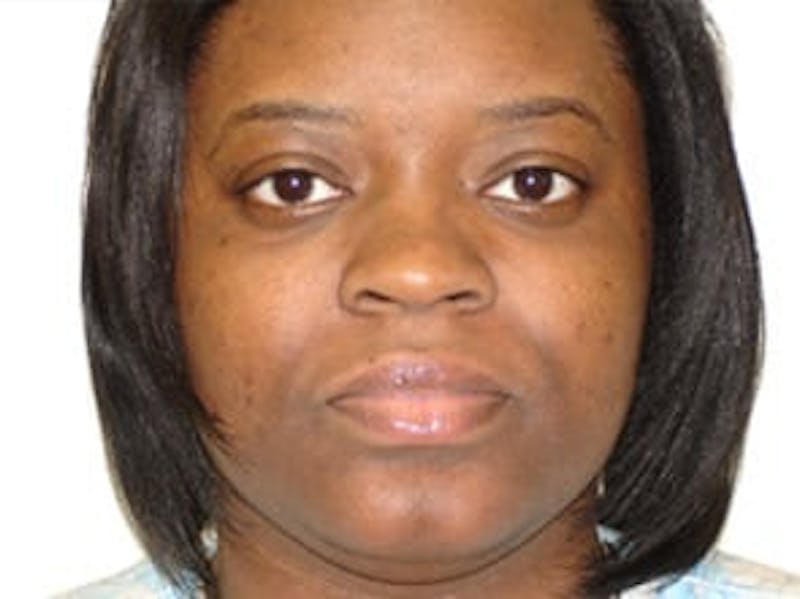 Ultherapy Before & After Gallery - Patient 133066483 - Image 1