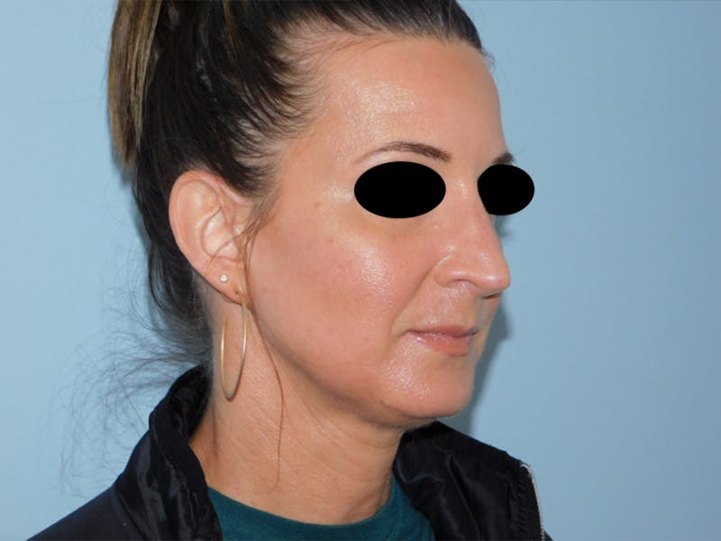 Rhinoplasty Before & After Gallery - Patient 133066496 - Image 8