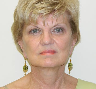 Blepharoplasty (Eyelid Lift) Before & After Gallery - Patient 133066487 - Image 2