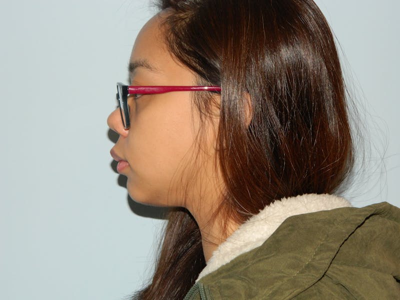 Chin Augmentation Before & After Gallery - Patient 133066486 - Image 2