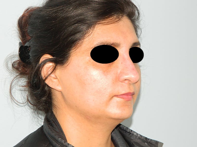 Non-Surgical Rhinoplasty and Injectable Fillers Before & After Gallery - Patient 133066481 - Image 4