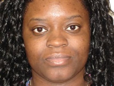 Ultherapy Before & After Gallery - Patient 133066483 - Image 2