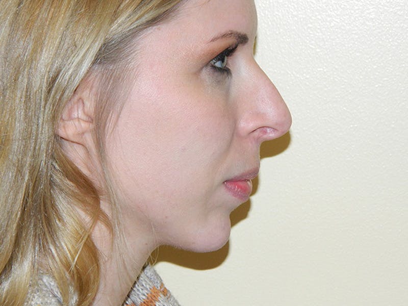 Revision Rhinoplasty Before & After Gallery - Patient 133066495 - Image 1