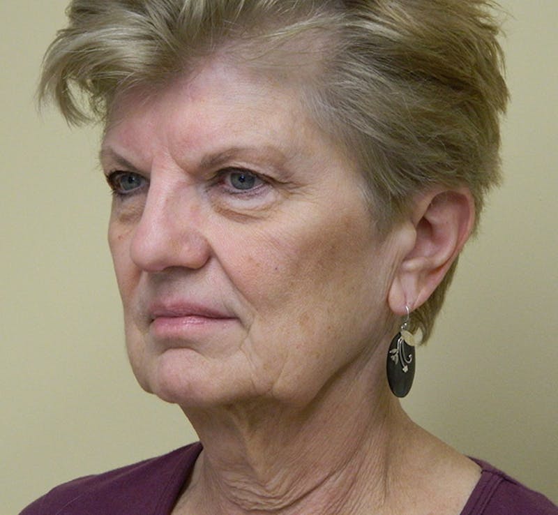 Blepharoplasty (Eyelid Lift) Before & After Gallery - Patient 133066487 - Image 3