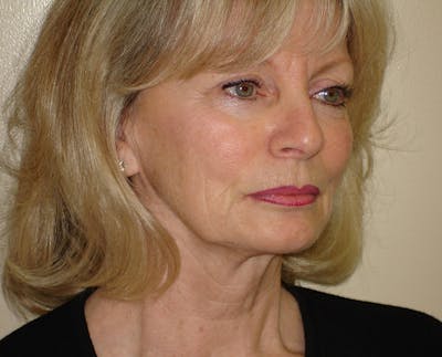 Mini-Facelift Before & After Gallery - Patient 133066492 - Image 1