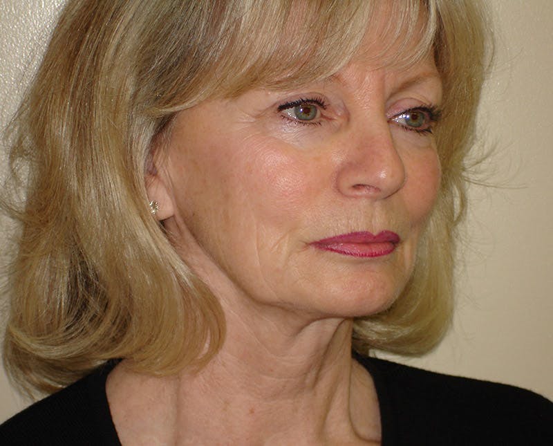 Mini-Facelift Before & After Gallery - Patient 133066492 - Image 1