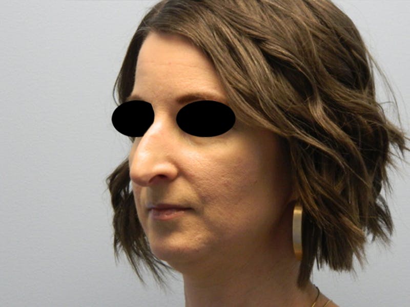 Rhinoplasty Before & After Gallery - Patient 133066496 - Image 9