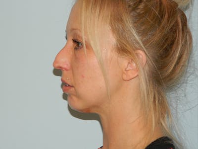 Non-Surgical Rhinoplasty and Injectable Fillers Before & After Gallery - Patient 133066489 - Image 1