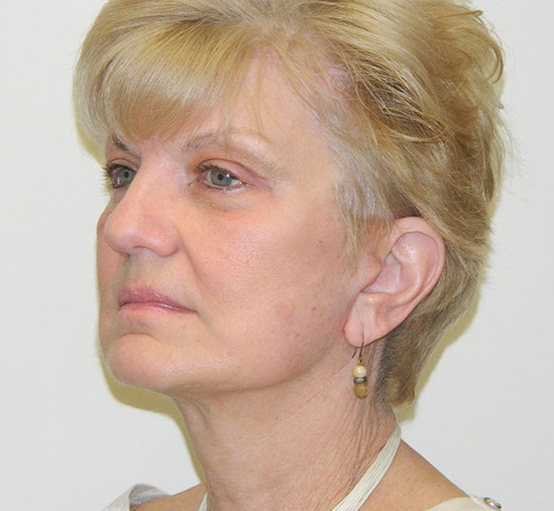 Blepharoplasty (Eyelid Lift) Before & After Gallery - Patient 133066487 - Image 4