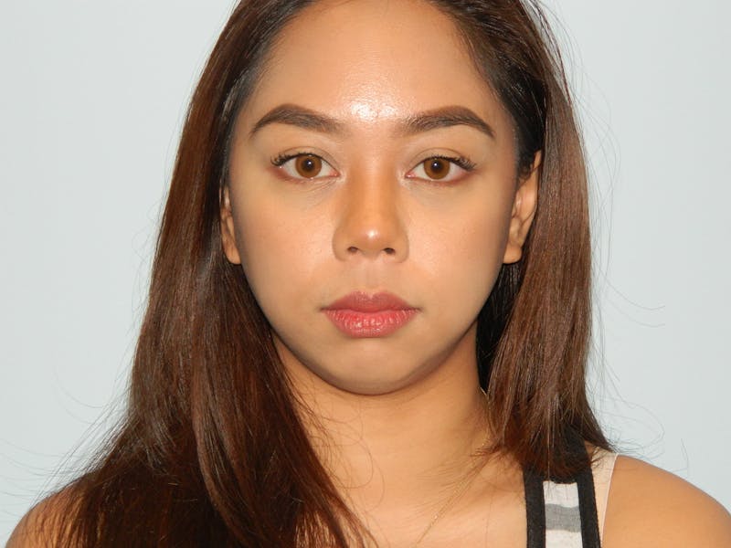 Chin Augmentation Before & After Gallery - Patient 133066486 - Image 3