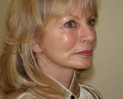 Mini-Facelift Before & After Gallery - Patient 133066492 - Image 2