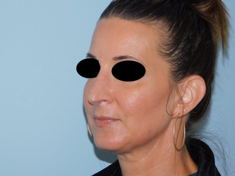 Rhinoplasty Before & After Gallery - Patient 133066496 - Image 10