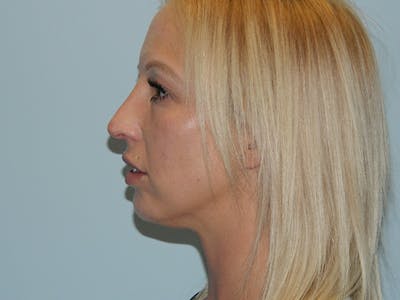 Non-Surgical Rhinoplasty and Injectable Fillers Before & After Gallery - Patient 133066489 - Image 2