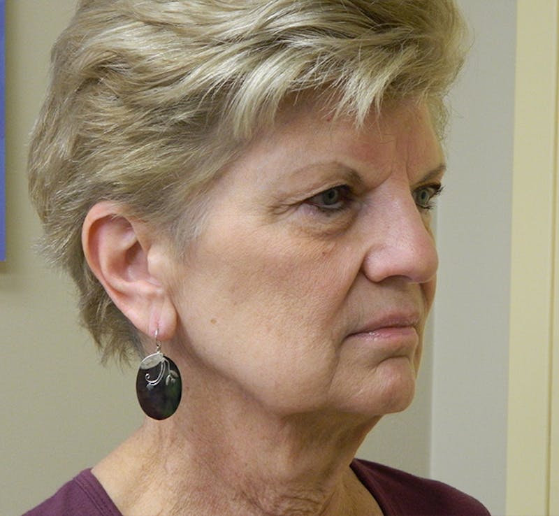Blepharoplasty (Eyelid Lift) Before & After Gallery - Patient 133066487 - Image 5