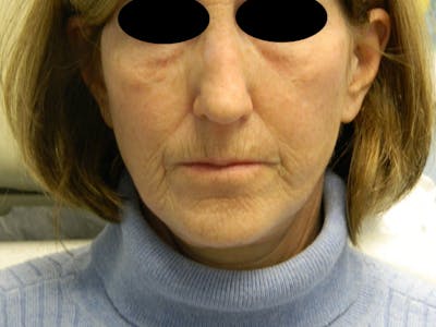 Fraxel Laser Resurfacing Before & After Gallery - Patient 133066488 - Image 1